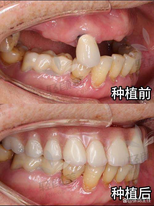 亲测北京劲松口腔all on 4全口种植牙，揭秘种牙费用和种植专家实力情况 