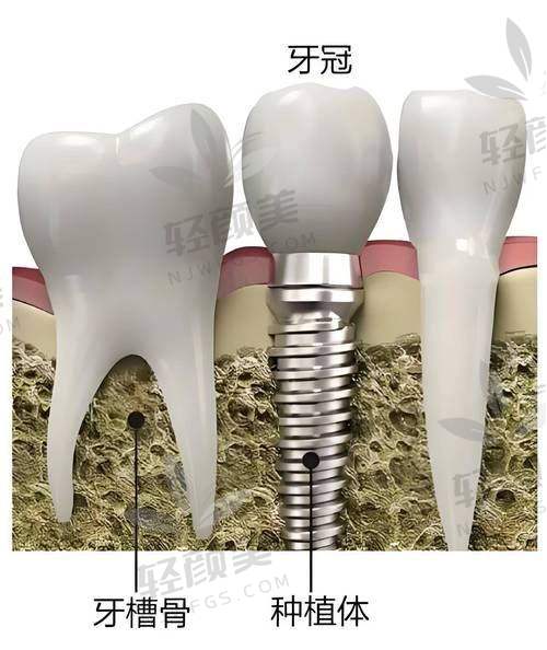 揭秘种牙费用