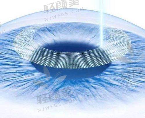 亲测北京朝聚眼科高旭全飞秒，手术体验棒，揭秘朝聚眼科全飞秒价格和专家实力