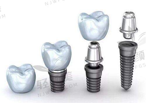 4️⃣ 百丹特（Biodenta） —— 后起之秀中的当打之作