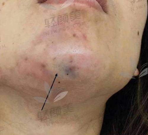 八、结语：伊婉玻尿酸丰唇值不值？看完你就知道！