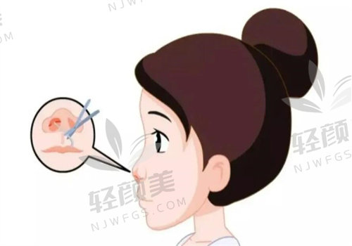 找拉萨维多利亚明高鹏肋骨隆鼻体验：术后鼻型立体，自然效果超满意！