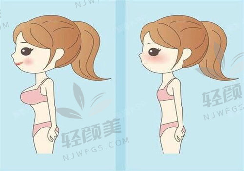2026 年隆胸修复价格一览表揭秘：各品牌假体隆胸型号价格、差异及选择攻略！