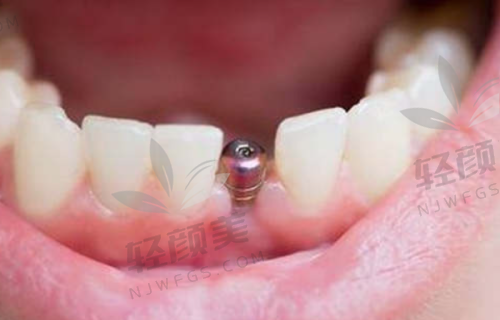 选择重庆团圆口腔和李志锋医生