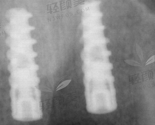 七、结语：瑞士种植牙不是智商税，选对品牌＝对口腔负责