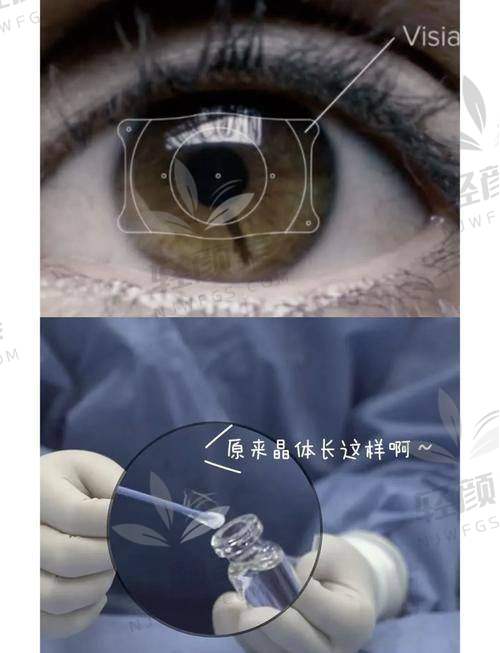 三、美国爱尔康人工晶体不同类型推荐：不止看预算，更看需求！