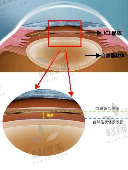 美国爱尔康人工晶体价格表曝光，单焦、三焦等不同类型差价这么大！