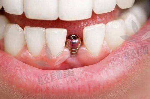 北京极简海德堡熊靖宇全口种植牙体验：近三十年经验医生，专属方案超贴心