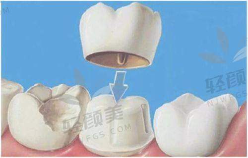 德国各品牌全瓷牙冠到底有啥不同？一口气说清！