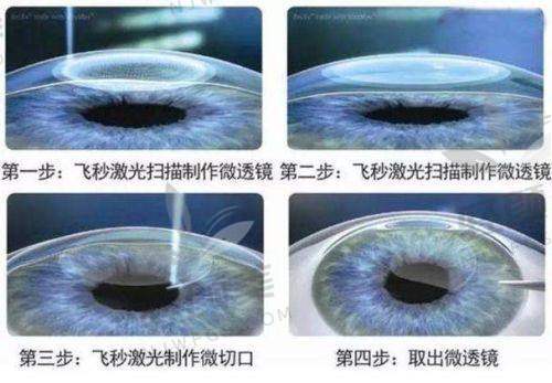 上海和平眼科翟爱琴全飞秒16800双眼体验，翟爱琴医生技术牛，效果超棒！