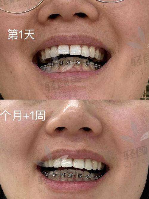 矫正过程中的定期复诊：见证牙齿的变化