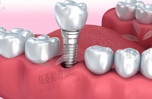 二、种植手术过程