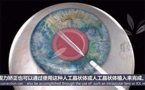 【甘肃爱尔眼视光医院(七里河院区)擅长什么项目】