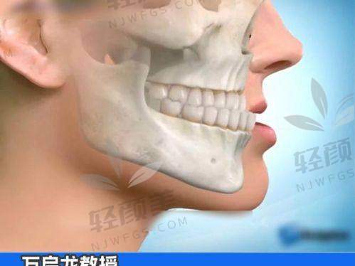 三、【广州偏颌矫正费用】何锦泉医生主刀，从学霸走向实力派