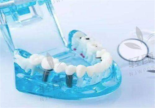 牙齿问题初现,种牙提上日程