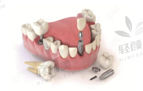 术后修复,成效超棒