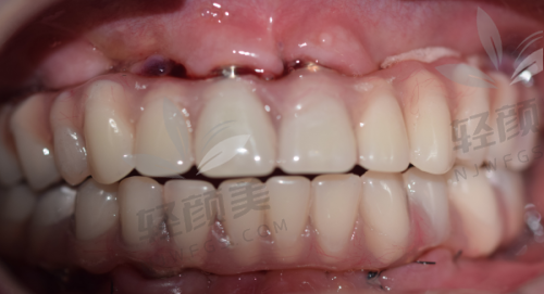 种牙过程,紧张又期待