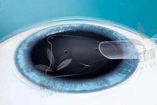 花27800在重庆普瑞找范光忠做晶体植入（不带散光），体验超棒效果绝了！