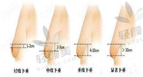 术前纠结与选择