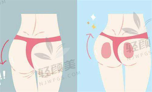 花3500在拉萨爱思特找郑波做单部位吸脂，效果惊艳，性价比直接拉满！