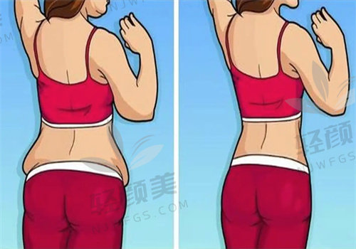 亲测！拉萨爱思特郑波做腰腹/大腿环吸仅9800，效果惊艳，秒变身材达人！