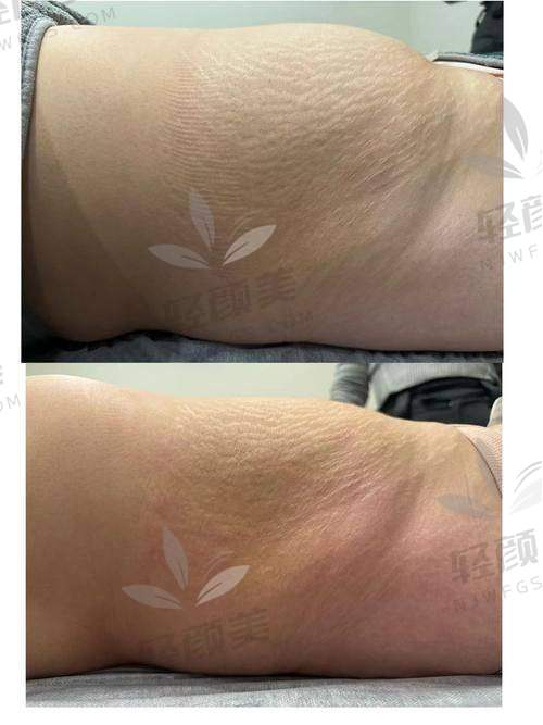 拉萨爱思特郑波单部位吸脂的技术优势