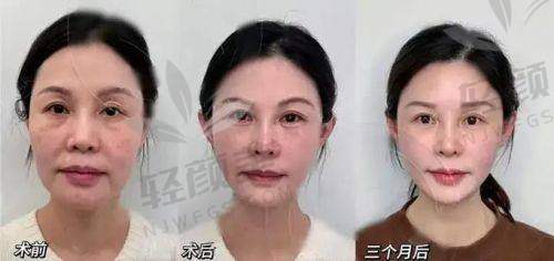 二、C型和V型哪个更适合你?这份差异表一眼看懂!