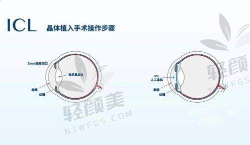 花32800在杭州柠盟眼科找沈晔做晶体植入，术后裸眼高清视界体验超棒！