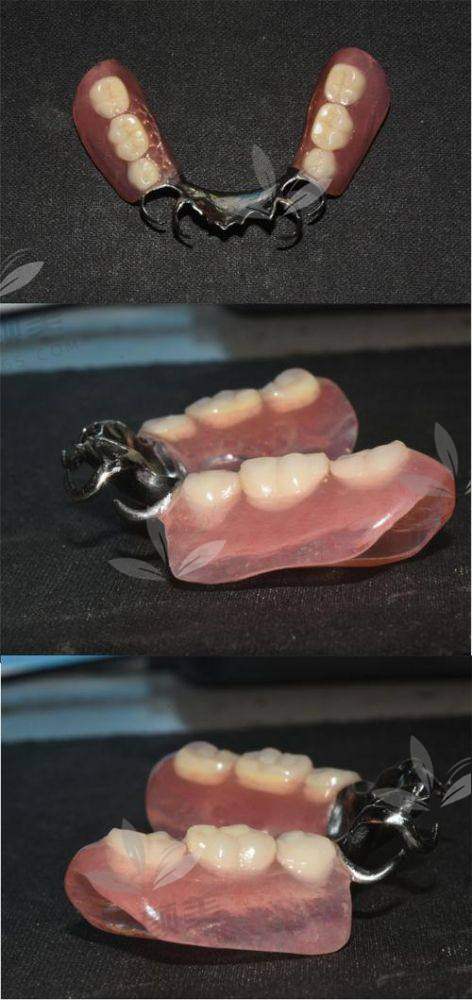 劲松口腔镶牙价格是否真良心?这波解析全程防坑