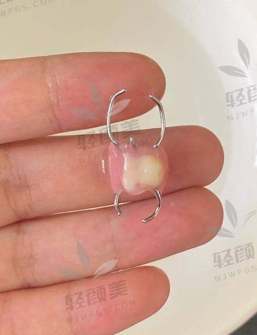 北京劲松口腔老年人吸附性义齿价格表大起底:从基础款到高配版