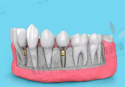 北京维乐口腔李永剑做瑞士ITI种植牙13000元起/颗,技术靠谱