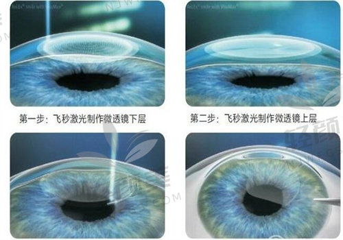 杭州柠盟眼科全飞秒手术体验：价格合理，医院靠谱，术后视力超清晰！