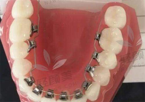 北京维乐口腔李世慧做青少年金属托槽国产矫正预约挂号方式