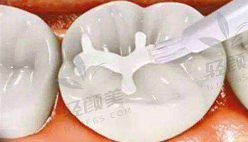 ?结语:补牙这件事,别只看价格,别随便凑合