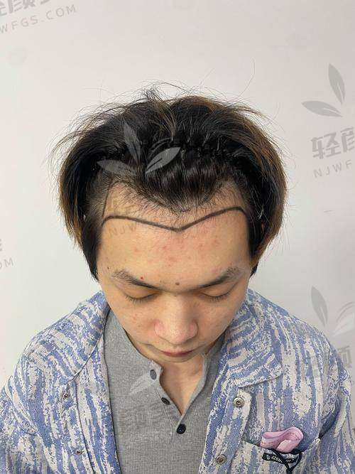 【兰州碧莲盛植发医院营业时间是什么时候】