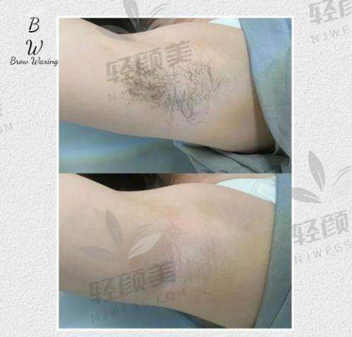 【兰州碧莲盛植发医院怎么样】