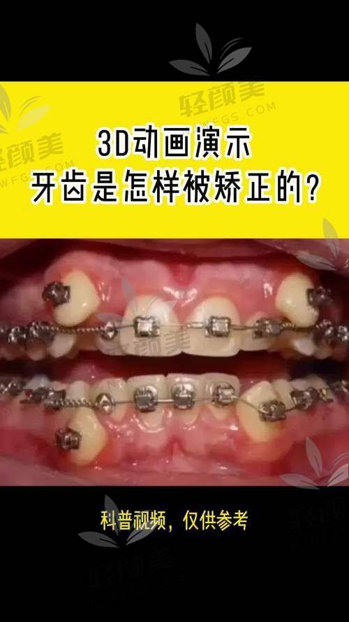 北京维乐口腔李世慧做青少年金属托槽国产矫正技术优势