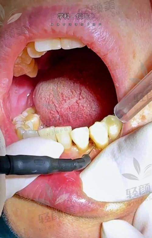 ?一、树脂材料到底是啥?为什么牙科 大夫都爱它?