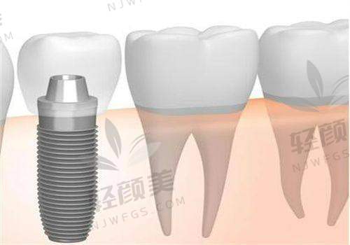 北京维乐口腔做儿童防龋涂氟价格300元起/次的合理性