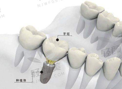 北京维乐口腔儿童防龋涂氟的成功实例