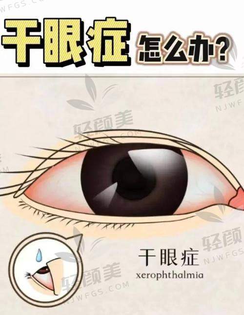 三、套路剧开播:干眼症手术“价格真相悬疑案”