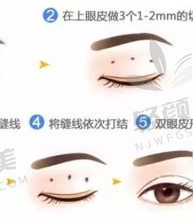 花12800元在新疆威兹曼找林仙保做眼综合，效果惊艳，医生负责体验超棒！