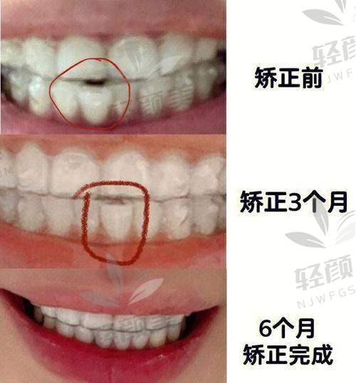 北京维乐口腔王峥做隐适美隐形矫正的技术优势