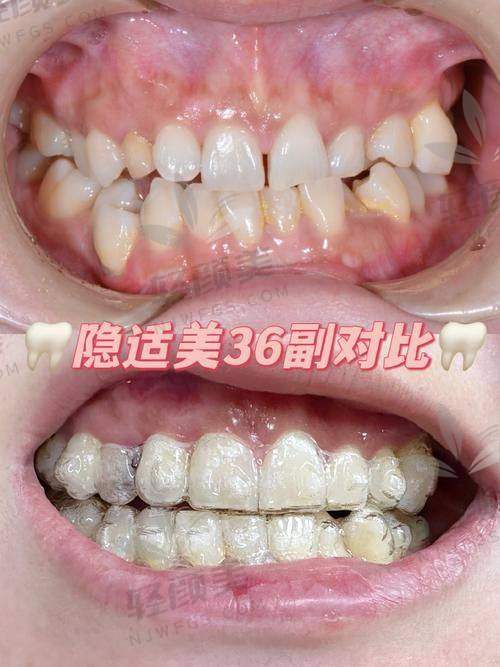 北京维乐口腔王峥做隐适美隐形矫正的预约挂号方式