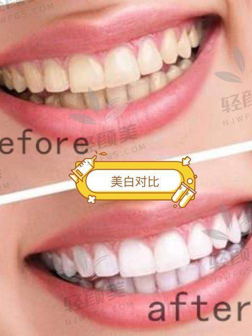 皓齿美白的过程