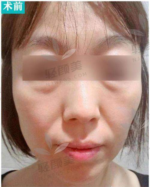 黄江泊医生做中下面部提升的技术优势