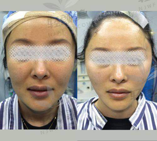 乌鲁木齐华美黄江泊做中下面部提升的成功实例