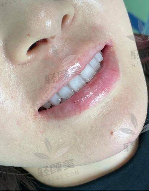 北京维乐口腔牙齿贴面实例分享