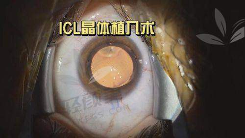 ICL 晶体植入 VS TICL 晶体植入，适用范围、价格等区别全揭秘！