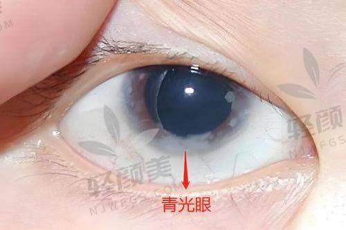 四、城市比一比——华厦青光眼手术价格谁最亲民?